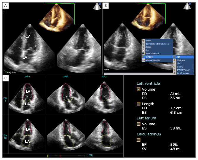 Echocardiographic Assessment of Left Ventricular Systolic Function: An  Overview of Contemporary Techniques, Including Speckle‐Tracking  Echocardiography