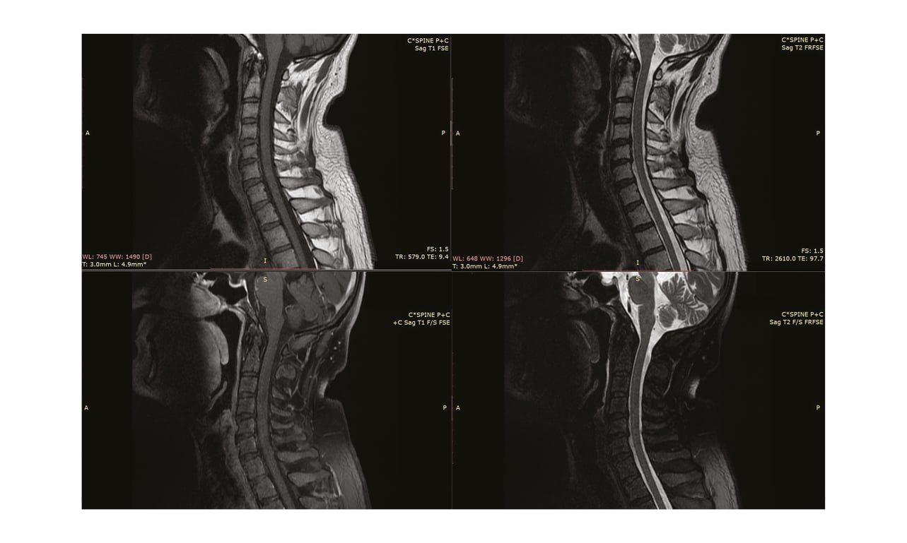 unilateral-facial-palsyin-guillain-barr-syndrome-a-hyperreflexic