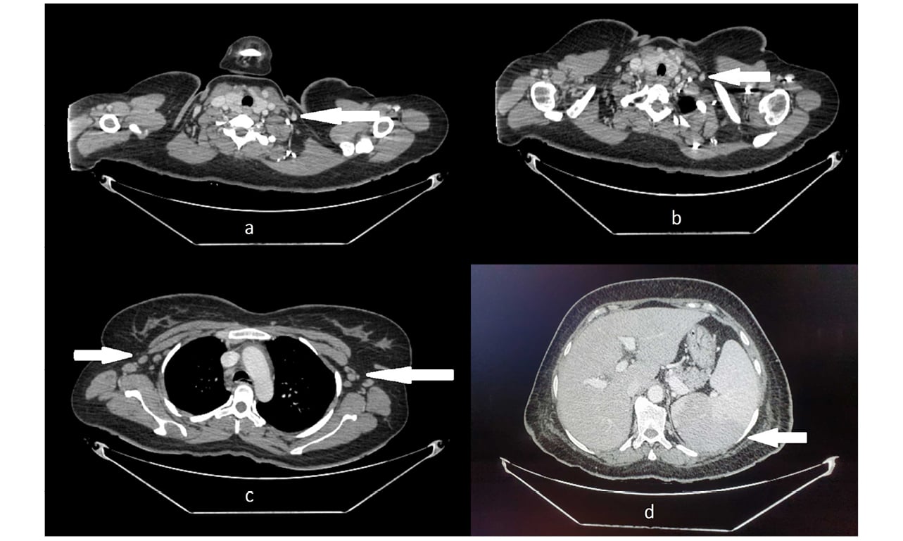 Adult-Onset Still’s Disease Complicated With Haemophagocytic ...