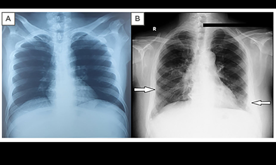 Interstitial Lung Disease: A Rare Association with Adult-Onset Still’s ...