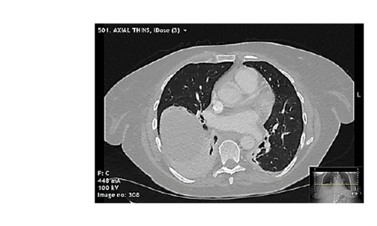 Dry Pericarditis With Rapid Progression To Tamponade As A Feature Of   Cardio Feature Images 1 